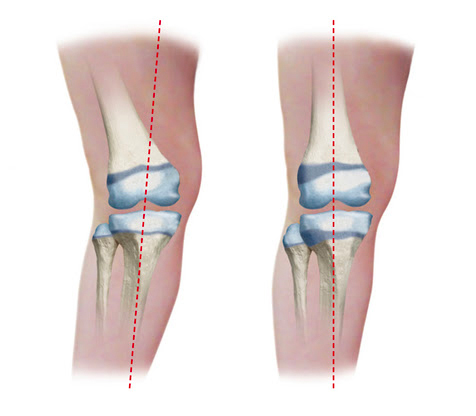 Angular deformity