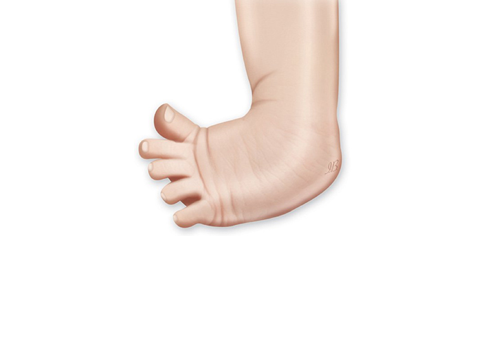 What Is Clubfoot? - Symptoms and Treatment