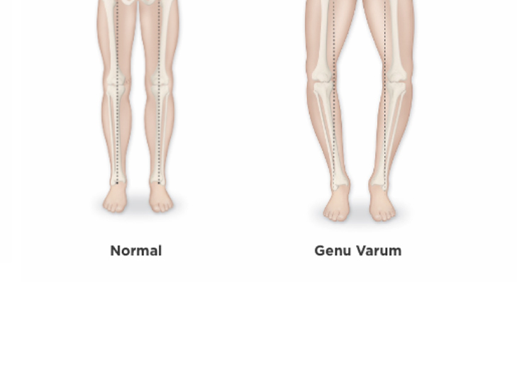 Genu Varum Bilat ral Genu Varum Traitement QPZO Genu Varum Bilat ral Genu Varum Traitement QPZO