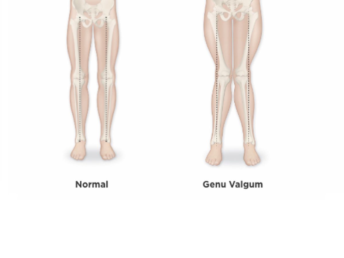 What is Genu Valgum? - OrthoFixKids