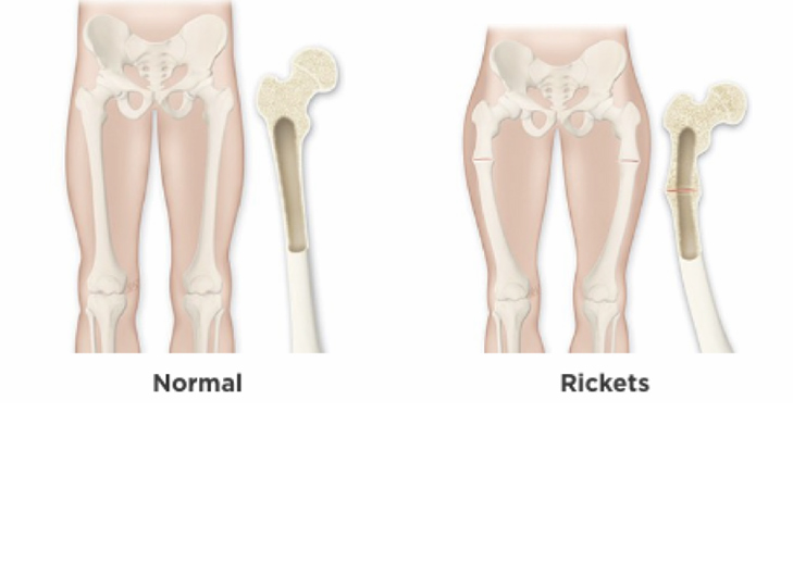 Rickets